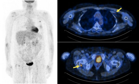 Vereos PET/CT